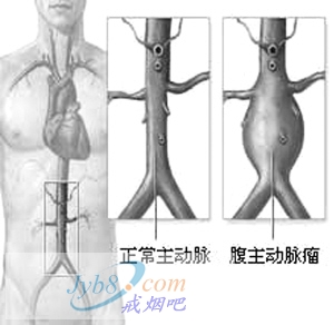 专家小组建议一次性筛查中老年男性吸烟者腹主动脉瘤