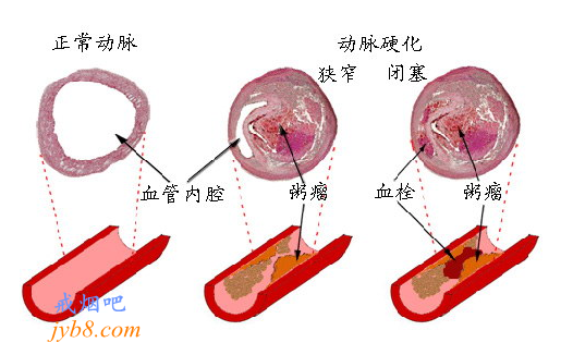 吸烟让年轻人血管老化